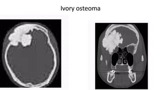 Ivory osteoma
 