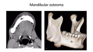 Mandibular osteoma
 