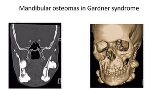 Mandibular osteomas in Gardner syndrome
 
