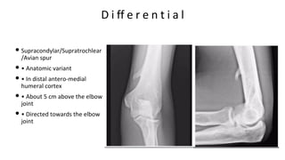 D i ff e r e n t i a l
• Supracondylar/Supratrochlear
/Avian spur
• • Anatomic variant
• • In distal antero-medial
humeral cortex
• • About 5 cm above the elbow
joint
• • Directed towards the elbow
joint
 