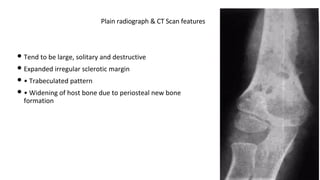 • Tend to be large, solitary and destructive
• Expanded irregular sclerotic margin
• • Trabeculated pattern
• • Widening of host bone due to periosteal new bone
formation
Plain radiograph & CT Scan features
 