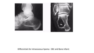 Differentials for intraosseous lipoma - SBC and Bone infarct
 