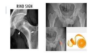 Benign bone tumor | PDF