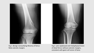 Fig 1. Benign nonossifying fibroma of femur.
Note sclerotic margins
Fig 2. Lytic epiphyseal and metaphyseal lesion
of distal femur without sclerotic margins,
consistent with giant cell tumor of bone
 