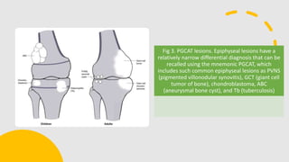 Fig 3. PGCAT lesions. Epiphyseal lesions have a
relatively narrow differential diagnosis that can be
recalled using the mnemonic PGCAT, which
includes such common epiphyseal lesions as PVNS
(pigmented villonodular synovitis), GCT (giant cell
tumor of bone), chondroblastoma, ABC
(aneurysmal bone cyst), and Tb (tuberculosis)
 