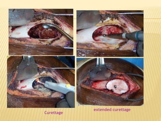 Curettage
extended curettage
 