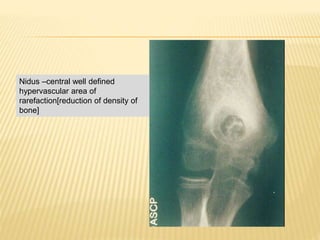 Nidus –central well defined
hypervascular area of
rarefaction[reduction of density of
bone]
 