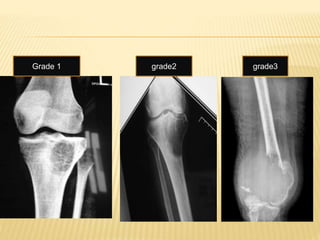 Grade 1 grade2 grade3
 