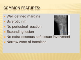 COMMON FEATURES:-
 Well defined margins
 Sclerotic rim
 No periosteal reaction
 Expanding lesion
 No extra-osseous soft tissue involvment
 Narrow zone of transition
 