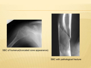SBC of humerus(truncated cone appearance)
SBC with pathological fracture
 