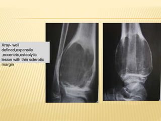 Xray- well
defined,expansile
,eccentric,osteolytic
lesion with thin sclerotic
margin
 