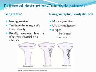 Benign bone tumors | PPTX