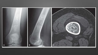 • M/C site- distal femur, Proximal tibia, Proximal Humerus
• Usually asymptomatic
• TREVOR DISEASE (Dysplasia Epiphysealis Hemimelia)
• Intra-articular epiphyseal
• MULTIPLE HERIDITARY EXOSTOSIS
• Autosomal dominant
• Mutation in EXT1 or EXT2 genes located at 8q24.11-13 location
• Present as multiple exostosis
• Associated with widening of metaphysis, bowing of long bones
 