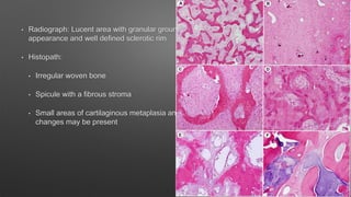 • Radiograph: Lucent area with granular ground glass
appearance and well defined sclerotic rim
• Histopath:
• Irregular woven bone
• Spicule with a fibrous stroma
• Small areas of cartilaginous metaplasia and cystic
changes may be present
 