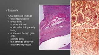 • Histology
• Characteristic findings
• cavernous space
• blood-filled
spaces without
endothelial lining cavity
lining
• numerous benign giant
cells
• spindle cells
• thin strands of woven
(new) bone present
 