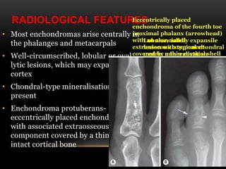 RADIOLOGICAL FEATURES
• Most enchondromas arise centrally in
the phalanges and metacarpals
• Well-circumscribed, lobular or oval
lytic lesions, which may expand the
cortex
• Chondral-type mineralisationmay be
present
• Enchondroma protuberans-
eccentrically placed enchondroma
with associated extraosseous
component covered by a thin shell of
intact cortical bone
Lobular, mildly expansile
lesion with typical chondral
matrix mineralisation
Eccentrically placed
enchondroma of the fourth toe
proximal phalanx (arrowhead)
with an associated
extraosseous component
covered by a thin cortical shell
 