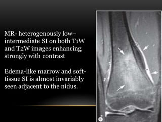 MR- heterogenously low–
intermediate SI on both T1W
and T2W images enhancing
strongly with contrast
Edema-like marrow and soft-
tissue SI is almost invariably
seen adjacent to the nidus.
 