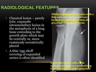 RADIOLOGICAL FEATURES
• Classical lesion – purely
lytic, expansile
intramedullary lesion in
the metaphysis of a long
bone extending to the
growth plate which may
be centrally or, more
commonly eccentrically
placed
• A thin ‘egg-shell’
covering of expanded
cortex is often identified
Mildly expansile lytic lesion with a
thin sclerotic margin (arrows)
located eccentrically within the
proximal tibial metaphysis
Expansile lesion with a thin
sclerotic margin (arrows) arising
from the surface of the proximal
 