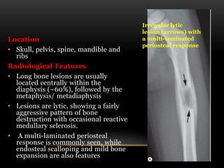 Location
• Skull, pelvis, spine, mandible and
ribs
Radiological Features
• Long bone lesions are usually
located centrally within the
diaphysis (~60%), followed by the
metaphysis/ metadiaphysis
• Lesions are lytic, showing a fairly
aggressive pattern of bone
destruction with occasional reactive
medullary sclerosis.
• A multi-laminated periosteal
response is commonly seen, while
endosteal scalloping and mild bone
expansion are also features
Irregular lytic
lesion (arrows) with
a multi-laminated
periosteal response
 