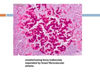 anastomosing bony trabeculae
separated by loose fibrovascular
stroma.
 