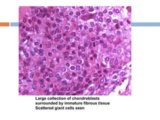 Large collection of chondroblasts
surrounded by immature fibrous tissue
Scattered giant cells seen
 