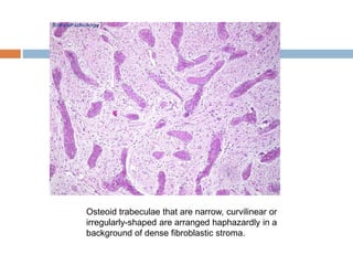 Osteoid trabeculae that are narrow, curvilinear or
irregularly-shaped are arranged haphazardly in a
background of dense fibroblastic stroma.
 