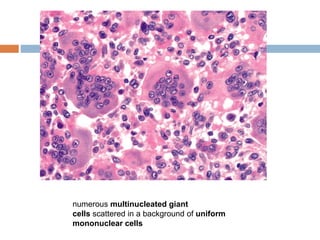 numerous multinucleated giant
cells scattered in a background of uniform
mononuclear cells
 