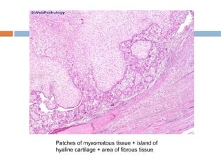 Patches of myxomatous tissue + island of
hyaline cartilage + area of fibrous tissue
 