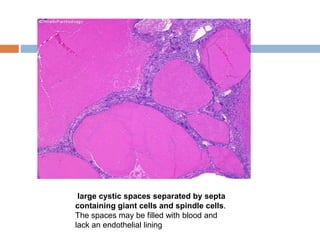 large cystic spaces separated by septa
containing giant cells and spindle cells.
The spaces may be filled with blood and
lack an endothelial lining
 