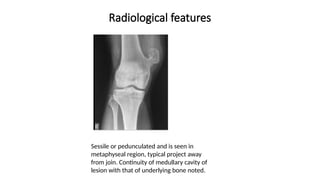 Radiological features
Sessile or pedunculated and is seen in
metaphyseal region, typical project away
from join. Continuity of medullary cavity of
lesion with that of underlying bone noted.
 