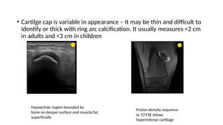 • Cartilge cap is variable in appearance – It may be thin and difficult to
identify or thick with ring arc calcification. It usually measures <2 cm
in adults and <3 cm in children
Hypoechoic region bounded by
bone on deeper surface and muscle/fat
superficially
Proton density sequence
or T2 FSE shows
hyperintense cartilage
 