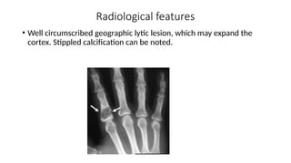 Radiological features
• Well circumscribed geographic lytic lesion, which may expand the
cortex. Stippled calcification can be noted.
 