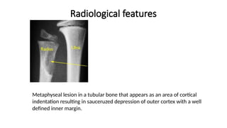 Radiological features
Metaphyseal lesion in a tubular bone that appears as an area of cortical
indentation resulting in sauceruzed depression of outer cortex with a well
defined inner margin.
 