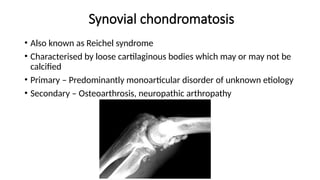 Synovial chondromatosis
• Also known as Reichel syndrome
• Characterised by loose cartilaginous bodies which may or may not be
calcified
• Primary – Predominantly monoarticular disorder of unknown etiology
• Secondary – Osteoarthrosis, neuropathic arthropathy
 