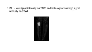 • MRI – low signal intensity on T1WI and heterogeneous high signal
intensity on T2WI
 