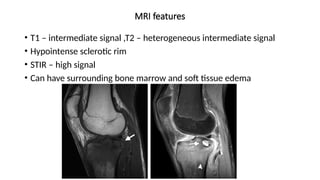 MRI features
• T1 – intermediate signal ,T2 – heterogeneous intermediate signal
• Hypointense sclerotic rim
• STIR – high signal
• Can have surrounding bone marrow and soft tissue edema
 