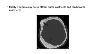 • Rarely osteoma may occur off the outer skull table and can become
quite large
 