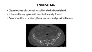ENDOSTEMA
• Discrete area of sclerosis usually called a bone island
• It is usually asymptomatic and incidentally found
• Common sites – Ischium, ilium, sacrum and proximal femur
 