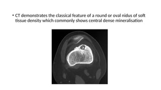 • CT demonstrates the classical feature of a round or oval nidus of soft
tissue density which commonly shows central dense mineralisation
 