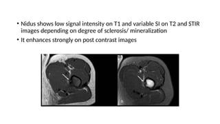 • Nidus shows low signal intensity on T1 and variable SI on T2 and STIR
images depending on degree of sclerosis/ mineralization
• It enhances strongly on post contrast images
 