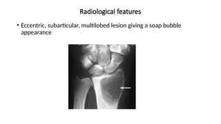 Radiological features
• Eccentric, subarticular, multilobed lesion giving a soap bubble
appearance
 
