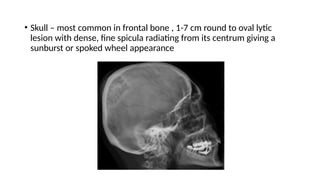 • Skull – most common in frontal bone , 1-7 cm round to oval lytic
lesion with dense, fine spicula radiating from its centrum giving a
sunburst or spoked wheel appearance
 