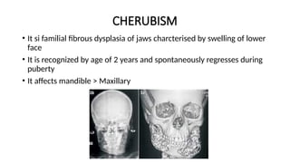 CHERUBISM
• It si familial fibrous dysplasia of jaws charcterised by swelling of lower
face
• It is recognized by age of 2 years and spontaneously regresses during
puberty
• It affects mandible > Maxillary
 