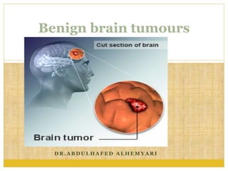 D R . A B D U L H A F E D A L H E M Y A R I
Benign brain tumours
 