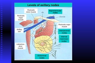 Levels of axillary nodes
              Pectoralis                Supraclavicular
             minor muscle                   nodes
Pectoralis
  major
 muscle

                                                   Pectoralis major
                                                       muscle
Axillary
 vein                                               Interpectoral
                                                        nodes

                                                      Internal
                                                     mammary
                                                       nodes
Latissimus
   dorsi
 muscle



                            Abdominal
                              nodes
 