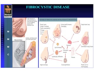 FIBROCYSTIC DISEASE
 