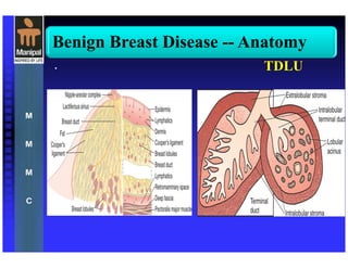 Benign Breast Disease -- Anatomy
• TDLU
 