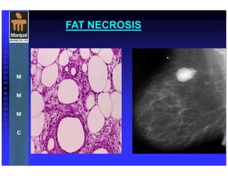 FAT NECROSIS
 
