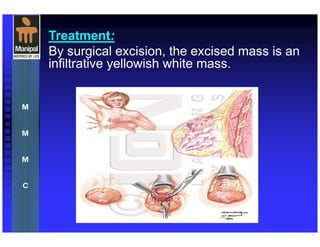 Treatment:
By surgical excision, the excised mass is an
infiltrative yellowish white mass.
 