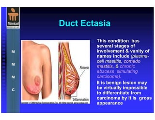 Duct Ectasia
 This condition has
several stages of
involvement & vanity of
names include (plasma-
cell mastitis, comedo
mastitis, & chronic
abscess simulating
carcinoma).
 It is benign lesion may
be virtually impossible
to differentiate from
carcinoma by it is gross
appearance
 